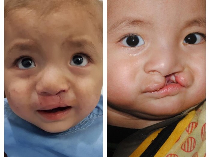 Cleft Lip operation in Afghanistan | LaunchGood | LaunchGood